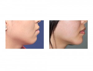 Jawline Reshaping result side view Dr Barry Eppley Indianapolis