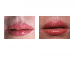 Lip Advancement Revisions front view Dr Barry Eppley Indianapolis