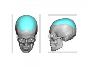 Skull Cap Imnplant Design Dr Barry Eppley Indianapolis