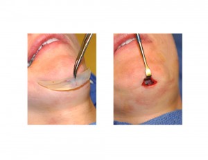 Small Incision for Chin Implant Dr Barry Eppley Indianapolis