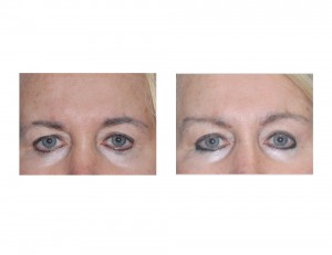 Temporal Browlift results front view Dr Barry Eppley Indianapolis