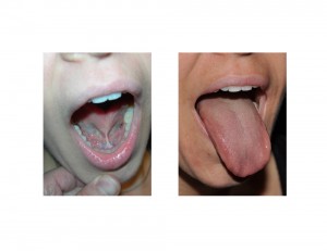 Adult Tongue Tie Release Tongue Mobility result Dr Barry Eppley Indianapolis