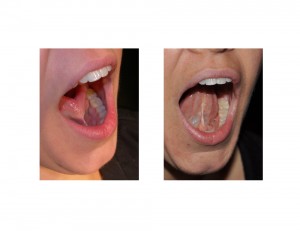 Adult Tongue Tie Release result Dr Barry Eppley Indianapolis