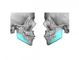 Custom Jawline Implant Designs for Facial Reconstruction after Orthognathic Surgery Dr Barry Eppley Indianapolis