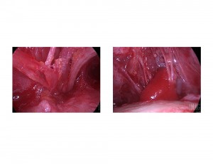 Endoscopic Supraorbital nerve decompression with gelfoam sponge