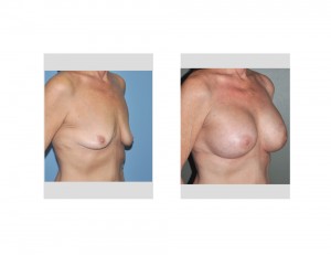 Older Breast Augmentation result oblique view Dr Barry Eppley Indianapolis