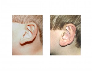 Otoplasty left ear side view result Dr Barry Eppley Indianapolis