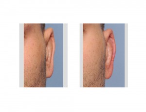 Reversal Otoplasty Left Ear results Dr Barry Eppley Indianapolis