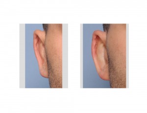 Reversal Otoplasty Right Ear results Dr Barry Eppley Indianaplis