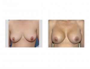 Silver Breast Augmentation result front view Dr Barry Eppley Indianspolis