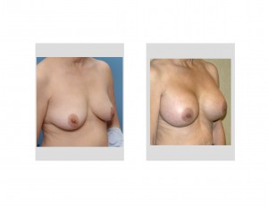 Silver Breast Augmentation result obique view Dr Barry Eppley Indianapolis