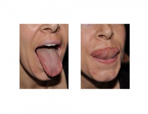 Tongue Mobility after Tongue Tie Release Dr Barry Eppley Indianapolis