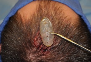 sagittal skull implant indianapolis indiana