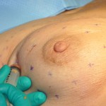 Breast Fat Injections Dr Barry Eppley Indianapolis