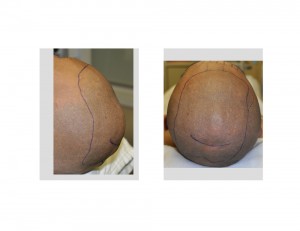 Custom Skull Cap Implant incision Dr Barry Eppley Indianapolis