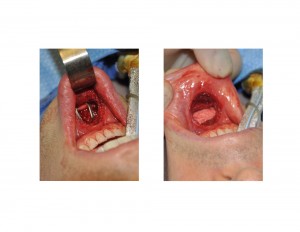 Hydroxyapatite Block Sliding Genioplasty intraoperative view Dr Barry Eppley Indianapolis