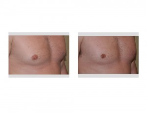 Indianapolis Male Nipple Reduction Dr Barry Eppley