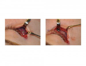 Infraorbital Rim Implant Screw Fixation Dr Barry Eppley Indianapolis