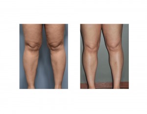 Knee and Calf Liposuction result front view