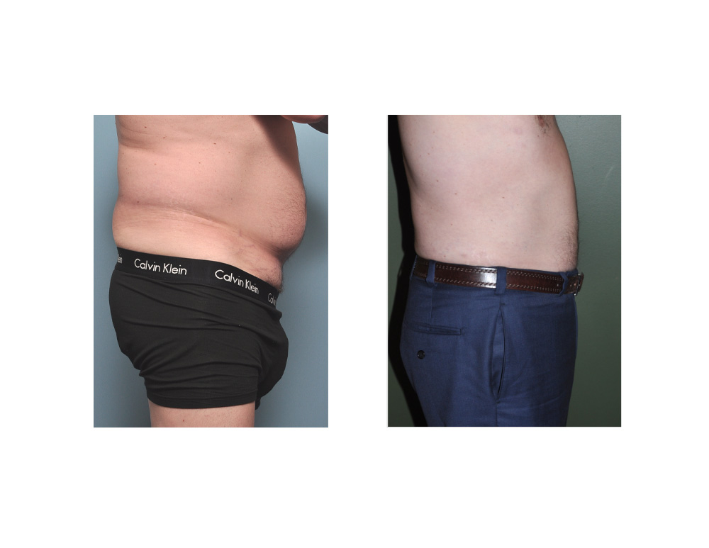 Liposuction of the Love Handles or Flanks  Reduce Sides, Love Handles and  Flanks with Liposuction 