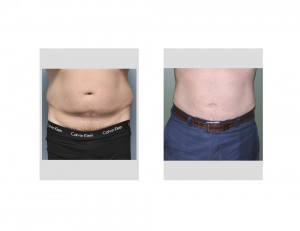 Male Abdominal Flank Liposuction result front view. Dr Barry Eppley Indianapolisjpg
