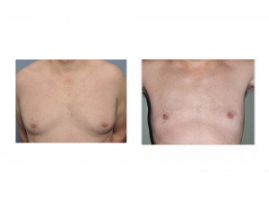 Male GYnecomastia Liposuction Reduction result front view