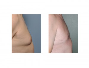 Male Gynecomastia Liposuction Reduction side view 2