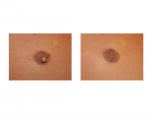 Male Nipple Reduction Surgery Dr Barry Eppley Indianapolis