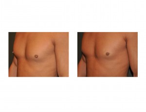 Male Nipple Reduction Surgery Results Dr Barry Eppley Indianapolis