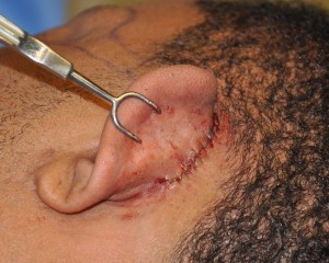 Postauricular Incision Closure for Temporal Reduction Dr Barry Eppley Indianapolis