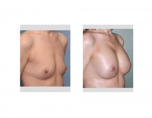 Anatomic Shaped Breast Augmentation result oblique view Dr Barry Eppley Indianapolis