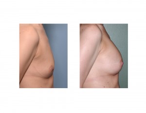 Anatomic Shaped Breast Augmentation result side view Dr Barry Eppley Indianapolis