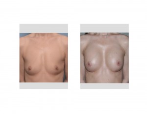 Anatomic Shaped Breast Implants Breast Augmentation result front view Dr Barry Eppley Indianapolis