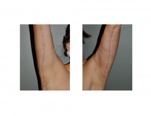 Armlift Scars Dr Barry Eppley Indianapolis