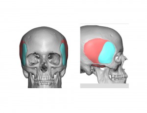 Extended Anterior Temporal Implant Dr Barry Eppley Indianapolis