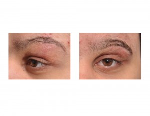 Eyebrow Transposition Flap Dr Barry Eppley Indianapolis