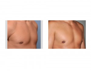 Fat Injections for Gynecomastia Reduction Retraction result oblique view