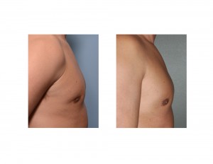 Fat Injections for Gynecomastia Reduction Retraction result side view