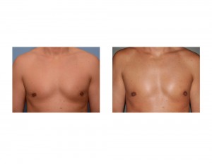 Fat Injections for Gynecomastia Reduction Retractrion result front view Dr Barry Eppley Indianapolis