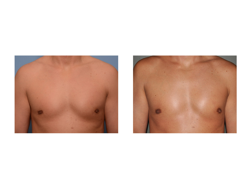 Blog Archivecase Study Injection Fat Grafting For The Gynecomastia