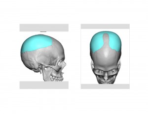 Head Widening Implant design Dr Barry Eppley Indianapolis