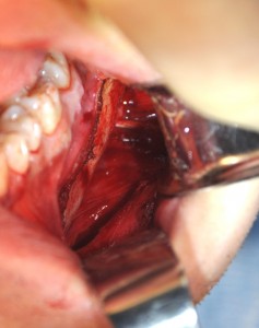 Jaw Angle Tendon (Stylomandibular Ligament in Jaw Angle Implant Surgery Dr Barry Eppley Indianapolis