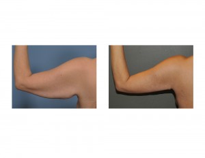 Left Armlift result back view Dr Barry Eppley Indianapolis