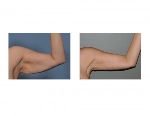 Left Armlift result front view Dr Barry Eppley Indianapolis