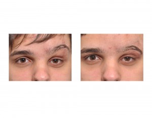 Left Eyelid Reconstruction with Transposition Flap Dr Barry Eppley Indianapolis