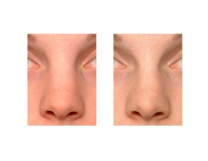 Nasal Osteotomies in Rhinoplasty Dr Barry Eppley Indianapolis