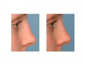 Nasal Osteotomies in Rhinoplasty result side view Dr Barry Eppley Indianapolis
