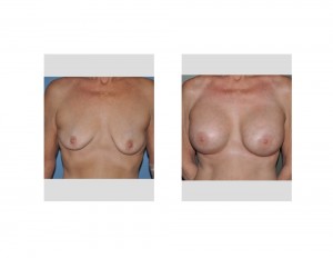 Older Breast Augmentation result front view Dr Barry Eppley Indianapolis