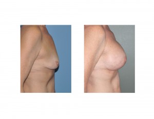 Older Breast Augmentation result side view Dr Barry Eppley Indianapolis