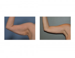 Right Armlift result front view Dr Barry Eppley Indianapolis